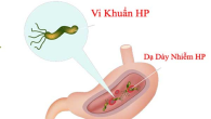 Nhiều trẻ mắc viêm dạ dày do nhiễm vi khuẩn HP