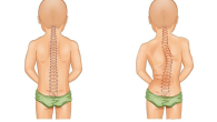 TRIỆU CHỨNG VÀ CÁCH KHẮC PHỤC CONG VẸO CỘT SỐNG Ở TRẺ EM