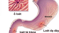 Người bị đau dạ dày cần tránh