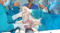 Những bất lợi cho trẻ khi mổ lấy thai