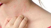 Đặc điểm sốt do virus HIV