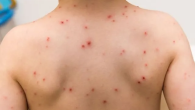 Triệu chứng điển hình của bệnh sởi cha mẹ không thể bỏ qua