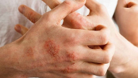 Giao mùa thận trọng với dị ứng thời tiết