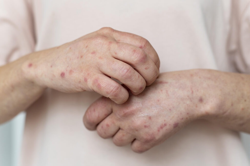 Một số cách ngăn ngừa nhiễm trùng cơ hội ở người nhiễm HIV 